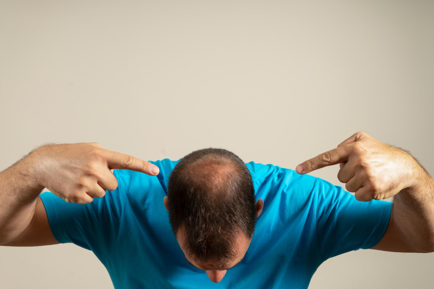 5 Ways to Combat Balding