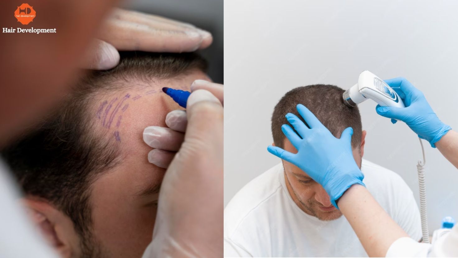 How Advanced Techniques Are Changing the Future of Hair Restoration?