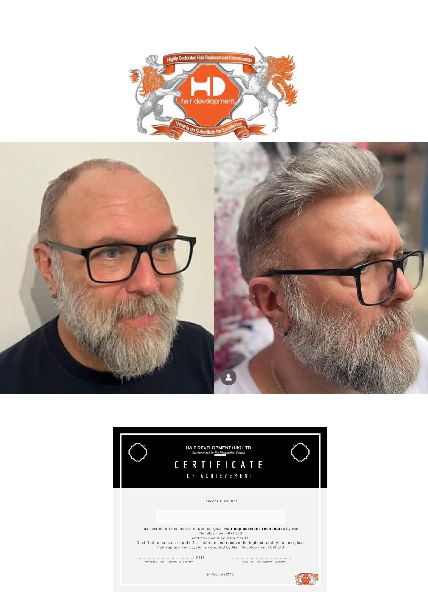 About Miracle Graft Hair Replacement (M.G.H.R.)